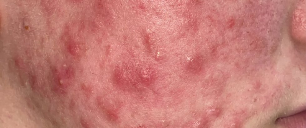 RESULT: 10-Dimension Solution for Acne-Stressed Skin