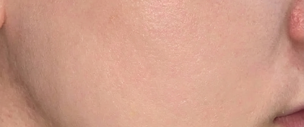 RESULT: 10-Dimension Solution for Acne-Stressed Skin